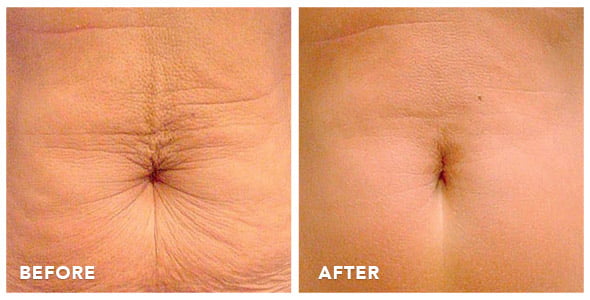 thermage-before-after-photos-02