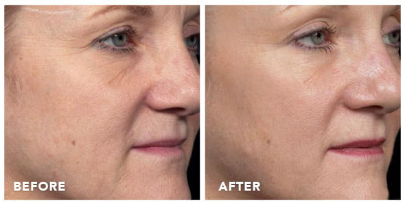 thermage-before-after-photos-03