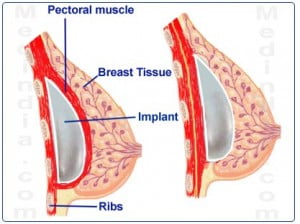 breast implant over or below the muscle