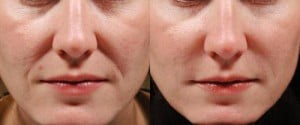 Juvederm treatment around the lips