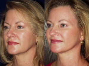 Facelift Before and After