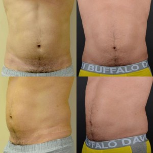 Liposuction Before and After Photo - Anderson Sobel Cosmetic Surgery