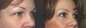 Eyelid Surgery Before and After Photo - Anderson Sobel Cosmetic Surgery