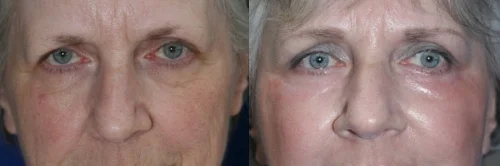 laser skin resurfacing before and after for wrinkles