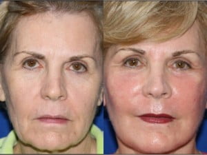 Mid Facelift Before and After Photo - Anderson Sobel Cosmetic Surgery