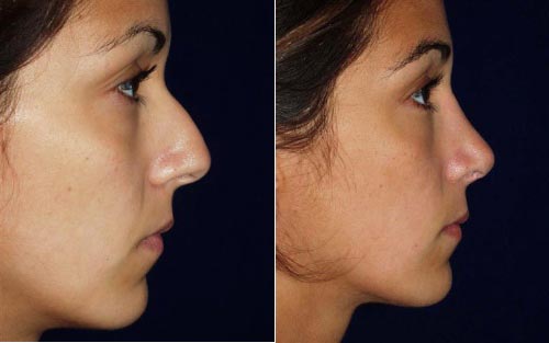rhinoplasty before and after photo