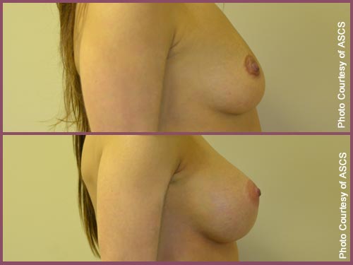 Before and after breast augmentation