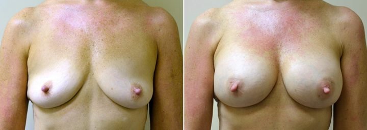 breast-augmentation-2329a-sobel