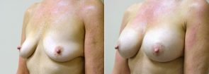 breast-augmentation-2329b-sobel