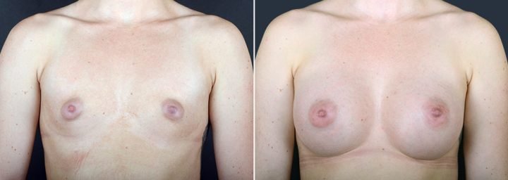 breast-augmentation-2351a-sobel