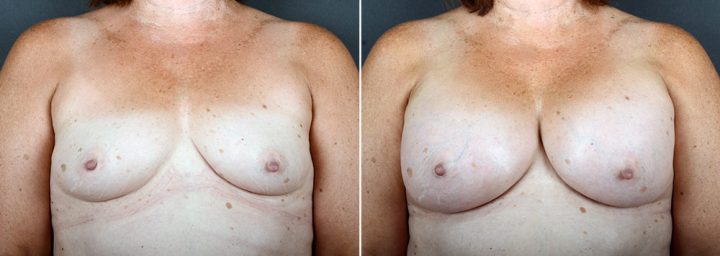 breast-augmentation-2362a-sobel