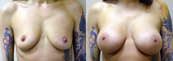 breast-augmentation-2511a-sobel