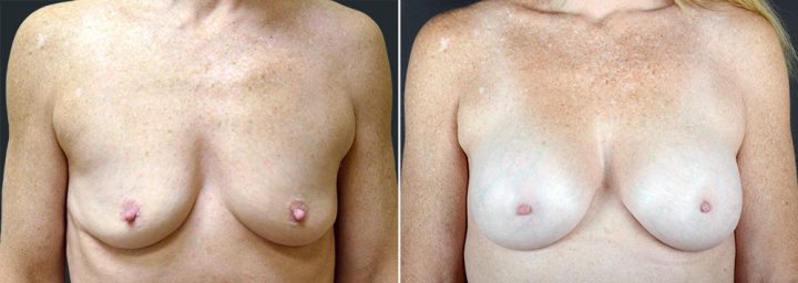 breast-augmentation-2592a-sobel