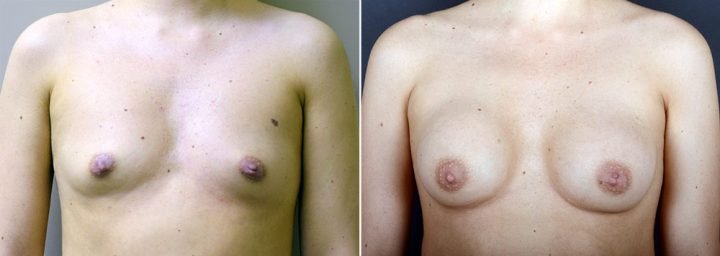 breast-augmentation-3421a-sobel