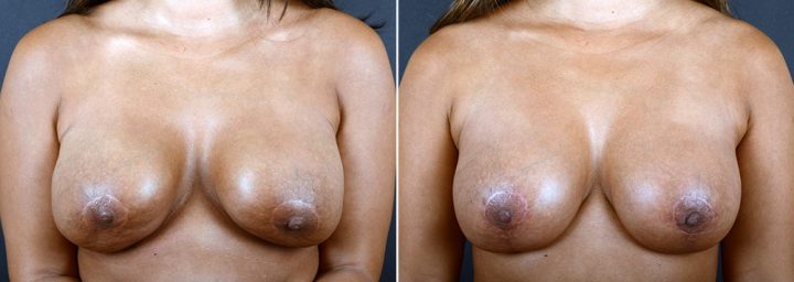 breast-augmentation-revision-2373a-sobel