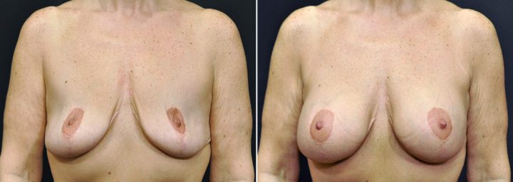 breast-augmentation-revision-with-lift-2587a-sobel