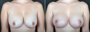 Breast Lift with Augmentation