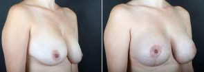 breast-lift-with-augmentation-2488b-sobel