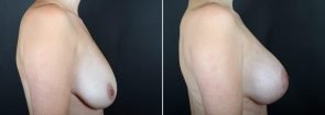 breast-lift-with-augmentation-2488c-sobel