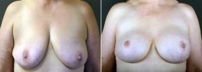 Breast Lift with Augmentation