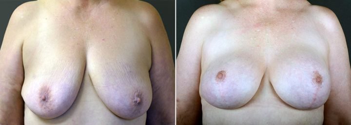 breast-lift-with-augmentation-2499a-sobel