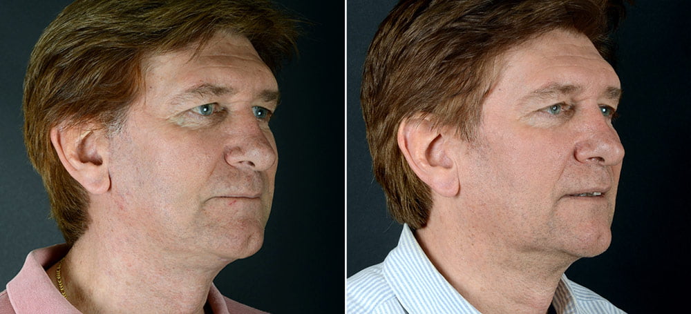 Before & after facelift surgery. Actual patient of Dr. Alex Sobel.*