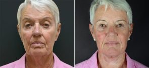 Facelift, Neck Lift