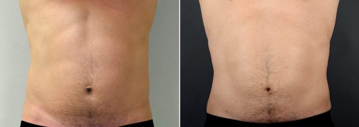 liposuction-male-2614a-sobel