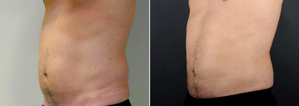 Before & after liposuction to the abdomen, waist and hips. Actual patient of Dr. Alex Sobel.*