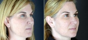 rhinoplasty-2452b-sobel