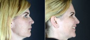 rhinoplasty-2452c-sobel