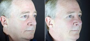 rhinoplasty-2465b-sobel