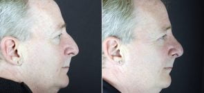 rhinoplasty-2465c-sobel