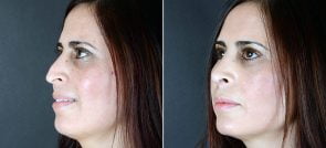 rhinoplasty-2523b-sobel