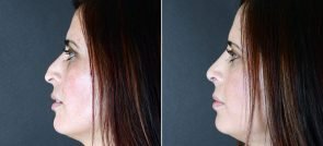 rhinoplasty-2523c-sobel