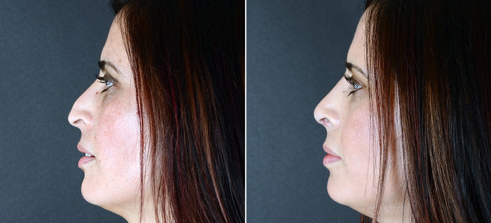 Before and after rhinoplasty with Seattle cosmetic surgeon Dr. Sobel