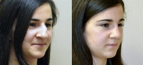 rhinoplasty-2967b-sobel