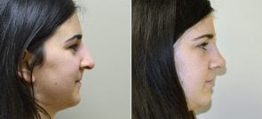 rhinoplasty-2967c-sobel