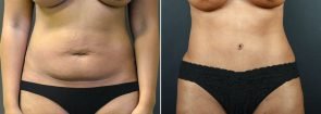 Tummy Tuck with Liposuction