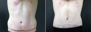 Tummy Tuck with Liposuction