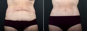 Tummy Tuck with Liposuction