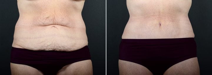 tummy-tuck-liposuction-2260a-sobel