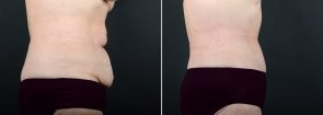 tummy-tuck-liposuction-2260c-sobel