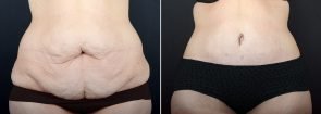 Tummy Tuck with Liposuction