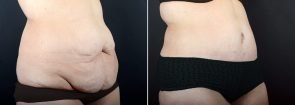 tummy-tuck-liposuction-2271b-sobel