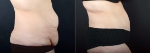 tummy-tuck-liposuction-2271c-sobel