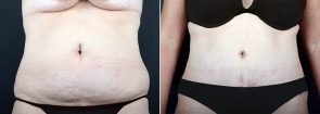 Tummy Tuck with Liposuction