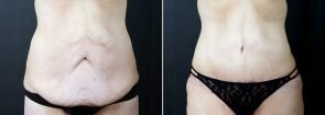 Tummy Tuck with Liposuction and Fat Transfer