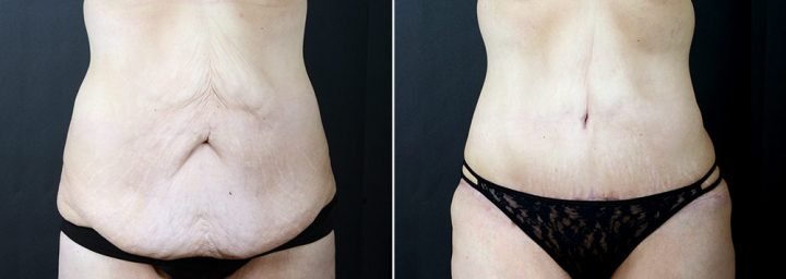 tummy-tuck-liposuction-2291a-sobel