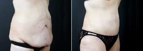 tummy-tuck-liposuction-2291b-sobel